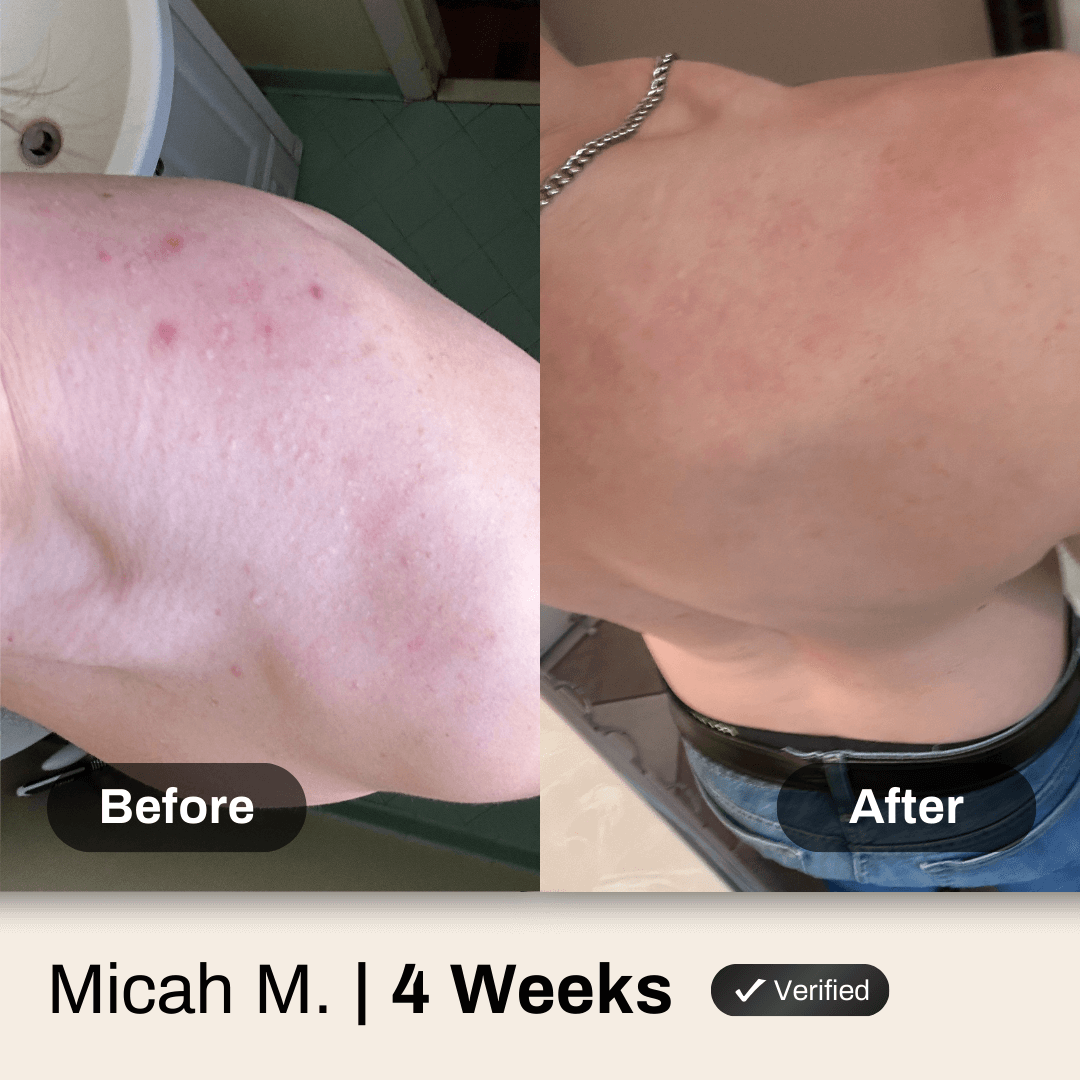 Shield Body Acne Wash