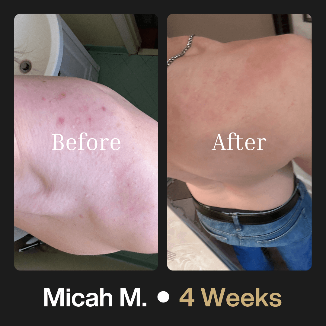 Shield Body Acne Wash