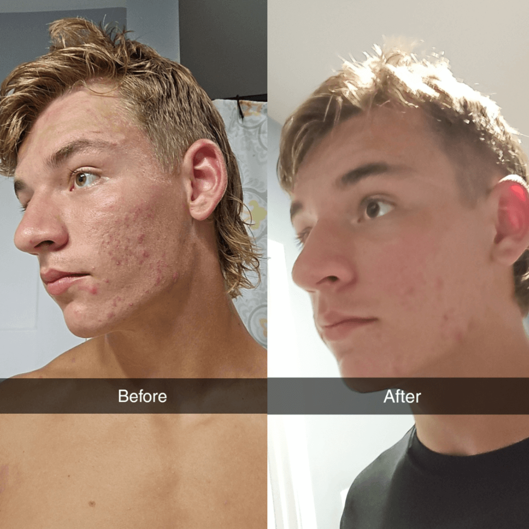 Shield System - 10 Reasons I trust Shield for Clear Skin