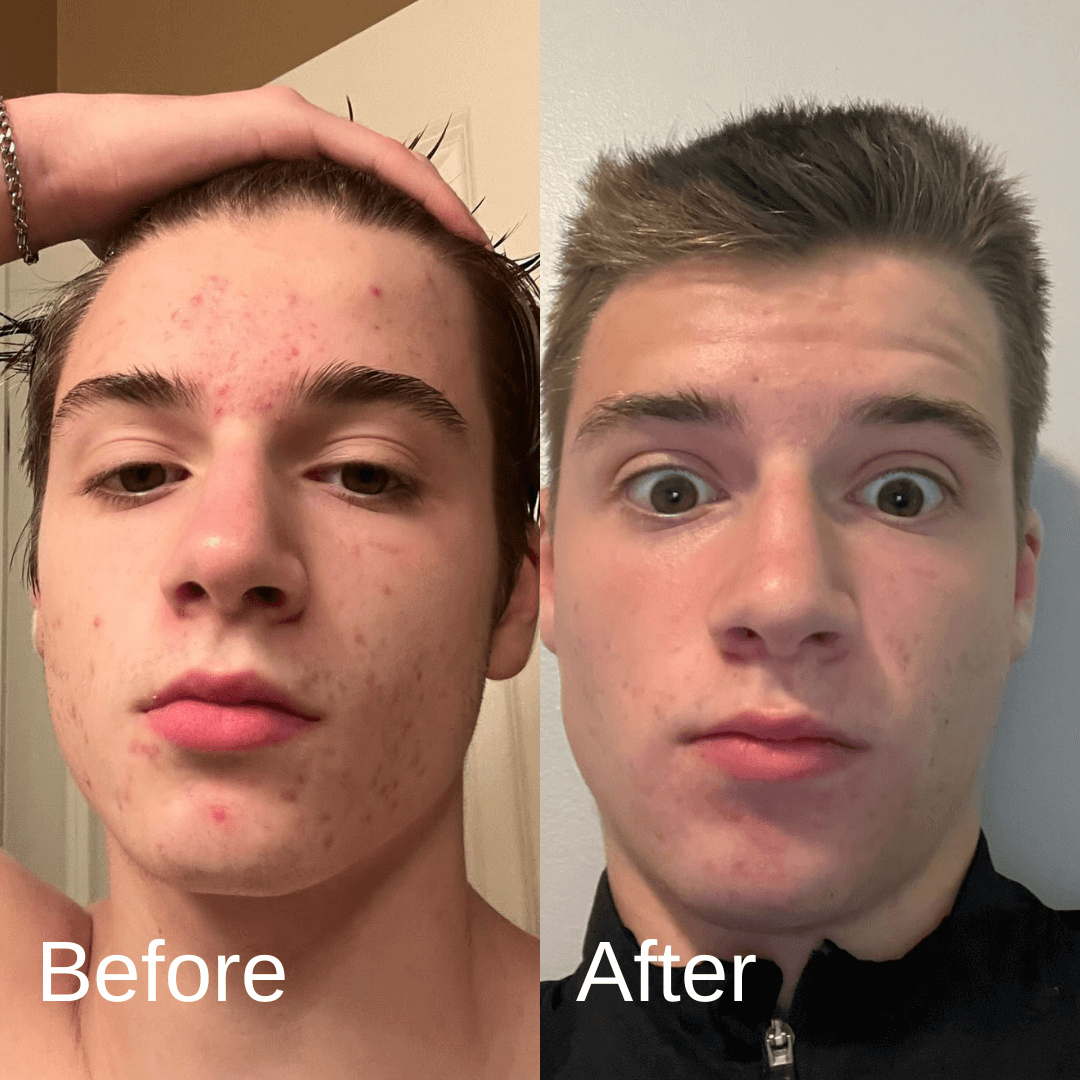 Shield System - 10 Reasons I trust Shield for Clear Skin